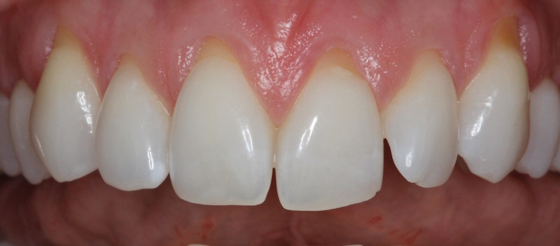 After Photo Connective Tissue Grafts