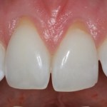 After Photo Connective Tissue Grafts