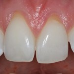 After Photo Connective Tissue Grafts