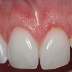 Picture After Connective Tissue Grafts