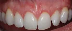 Picture After Connective Tissue Grafts