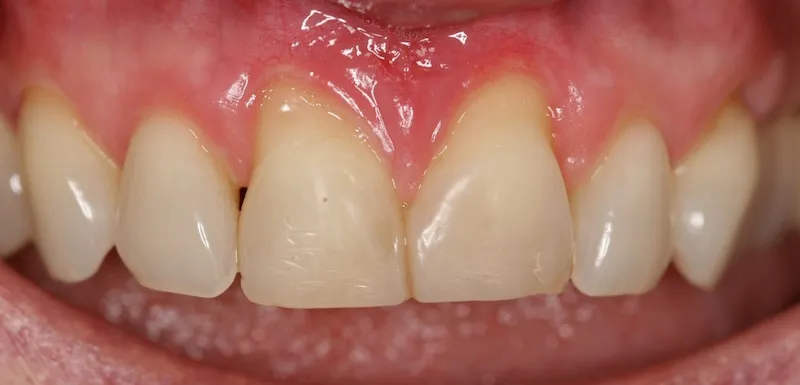 Picture Before Connective Tissue Grafts