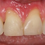 Picture Before Connective Tissue Grafts