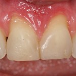 Picture Before Connective Tissue Grafts