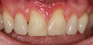 Picture Before Connective Tissue Grafts