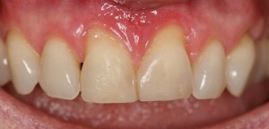 Picture Before Connective Tissue Grafts