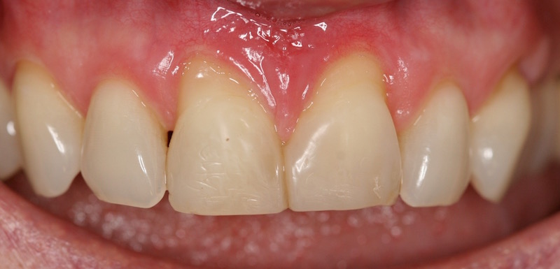 Picture Before Connective Tissue Grafts