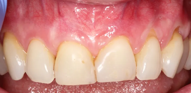 Picture Before Connective Tissue Grafts