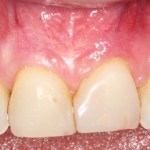 Picture Before Connective Tissue Grafts