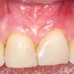 Picture Before Connective Tissue Grafts