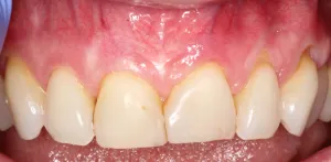Picture Before Connective Tissue Grafts