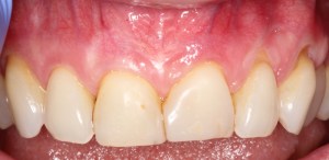 Picture Before Connective Tissue Grafts