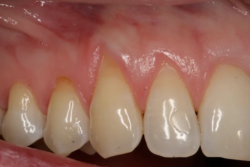 Picture of Teeth after gum grafting surgery