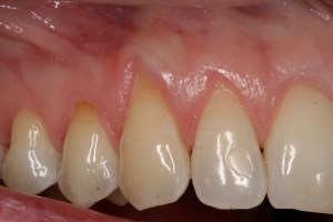 Picture of Teeth after gum grafting surgery