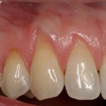 Picture of Teeth after gum grafting surgery