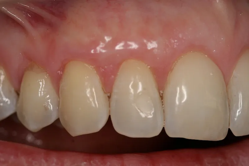 Picture of Teeth after gum grafting surgery