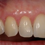 Picture of Teeth after gum grafting surgery