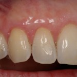 Picture of Teeth after gum grafting surgery