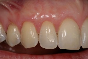 Picture of Teeth after gum grafting surgery