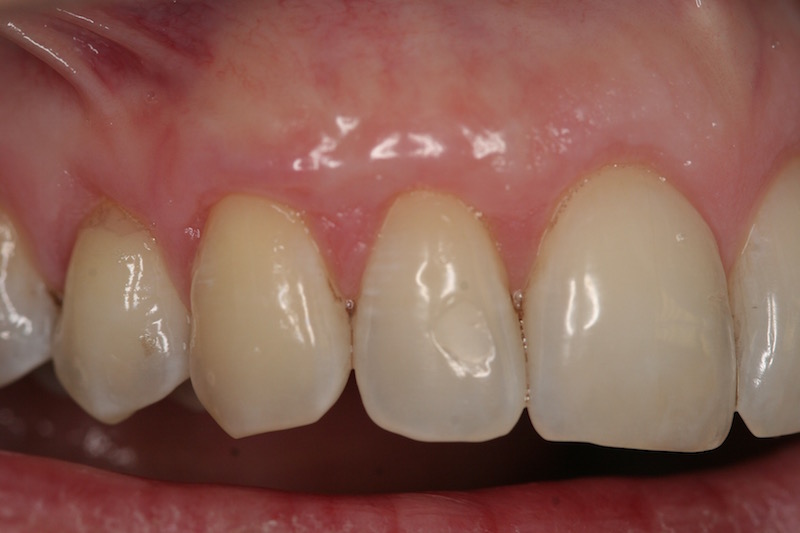 Picture of Teeth after gum grafting surgery