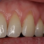 Image of Crown Lengthening Case