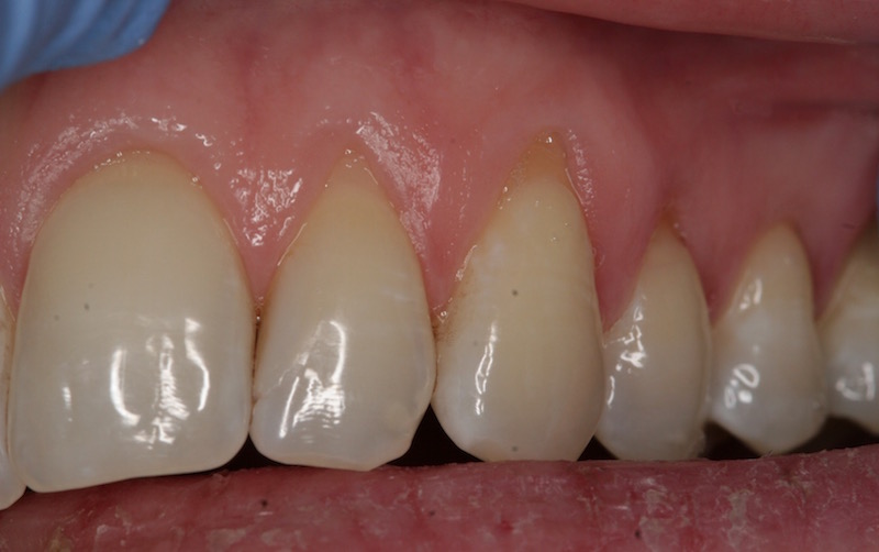 Image of Crown Lengthening Case