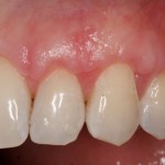 Crown Lengthening Case Image