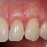 Crown Lengthening Case Image