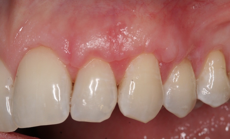 Crown Lengthening Case Image
