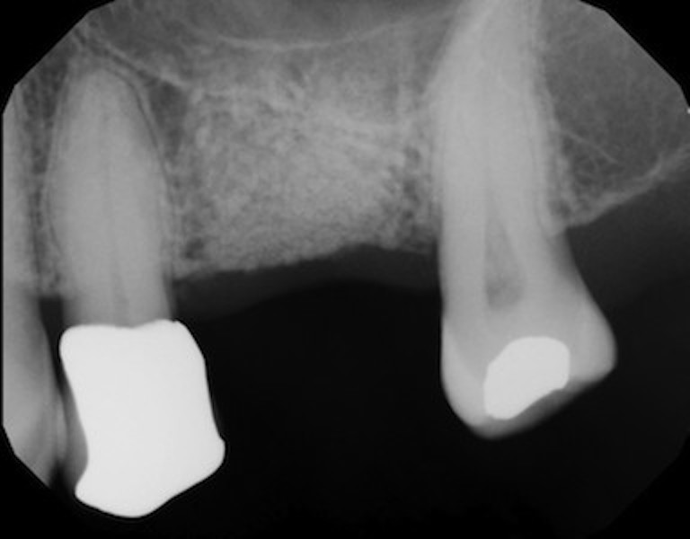 Sinus Augmentation