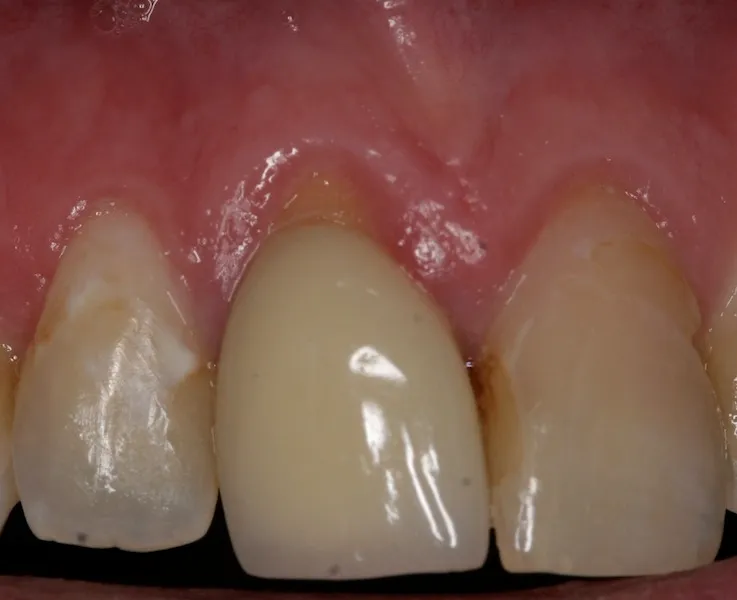 Image of receding gums