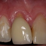 Image of receding gums