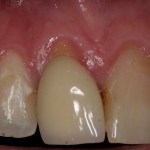 Image of receding gums