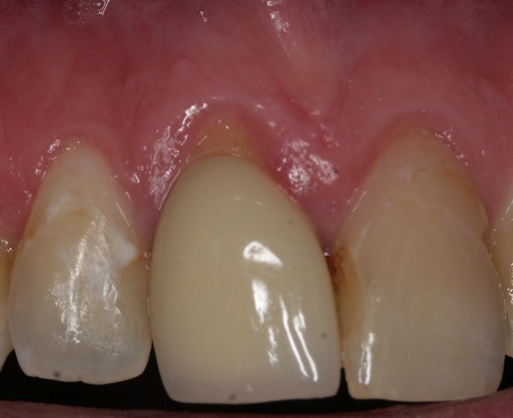 Image of receding gums