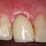Image of teeth after gum grafting treatment