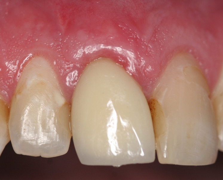 Image of teeth after gum grafting treatment