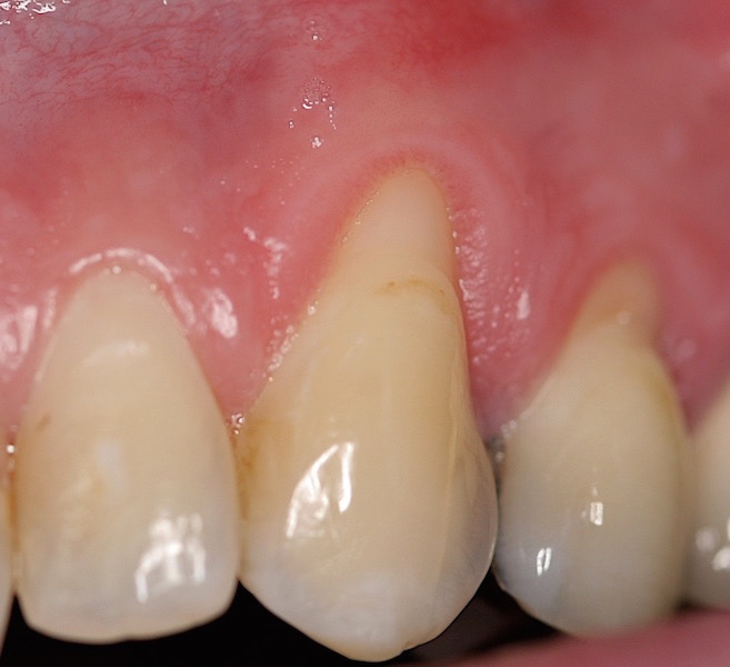 Photo of teeth before gum grafting treatment