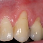 Photo of teeth before gum grafting treatment