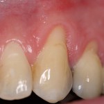 Photo of teeth before gum grafting treatment
