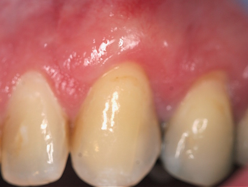 Photo of teeth before gum grafting treatment