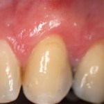 Photo of teeth before gum grafting treatment