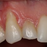 Cosmetic Periodontal Surgery