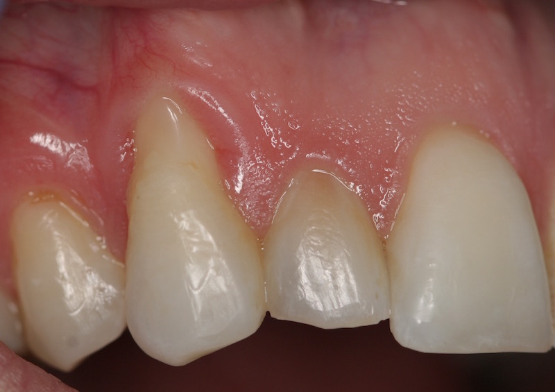 Cosmetic Periodontal Surgery
