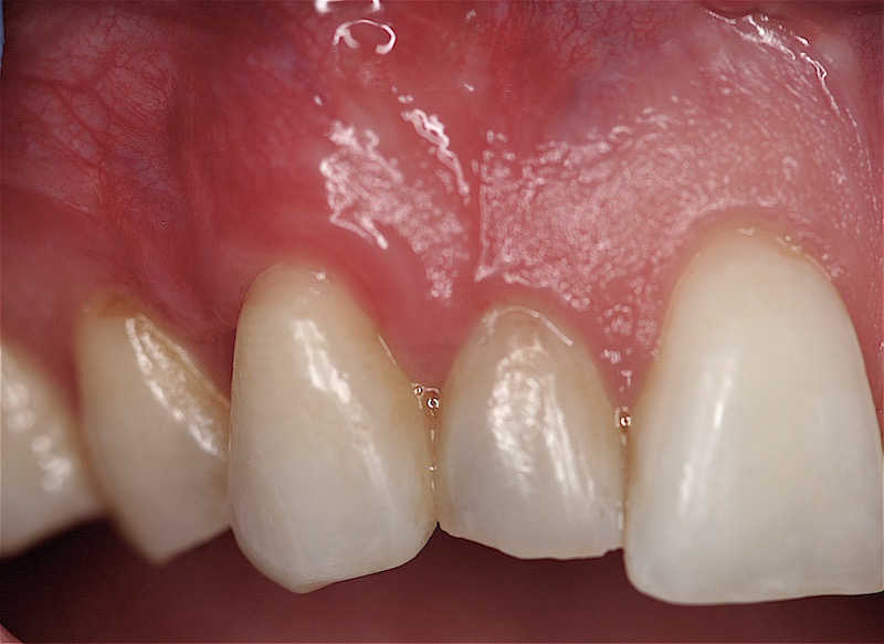Cosmetic Periodontal Surgery