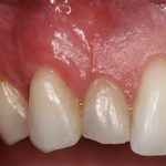 Cosmetic Periodontal Surgery