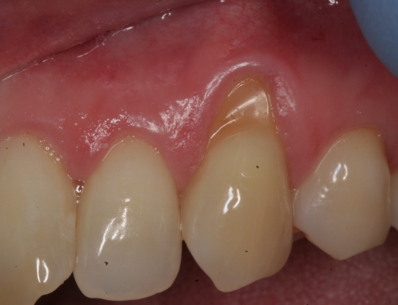 Photo of teeth after gum grafting treatment