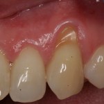 Photo of teeth after gum grafting treatment