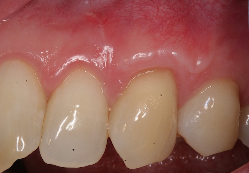 Photo of teeth after gum grafting treatment