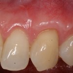 Photo of teeth after gum grafting treatment