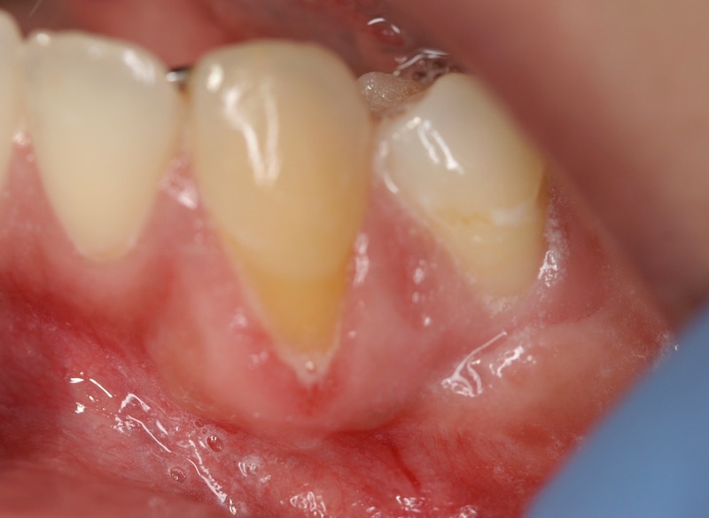Picture of Gums before Gum Grafting Treatment